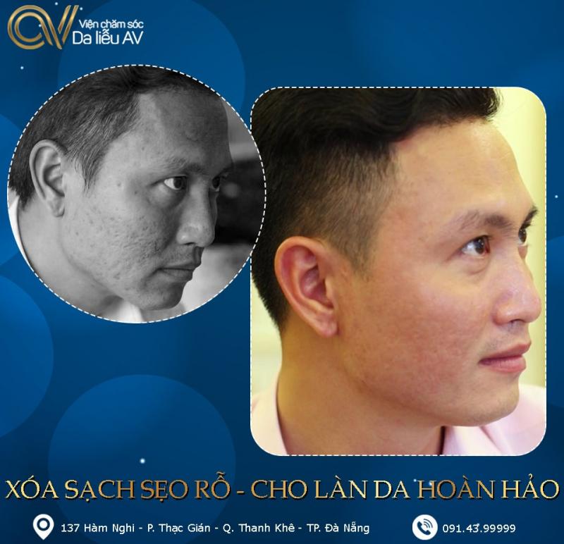 Viện Điều Trị Da Liễu AV Đà Nẵng