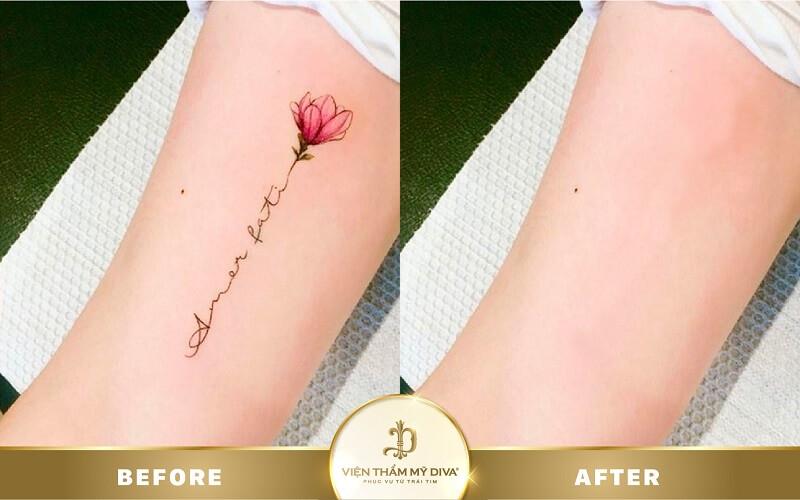 Xóa xăm tại Viện thẩm mỹ Diva