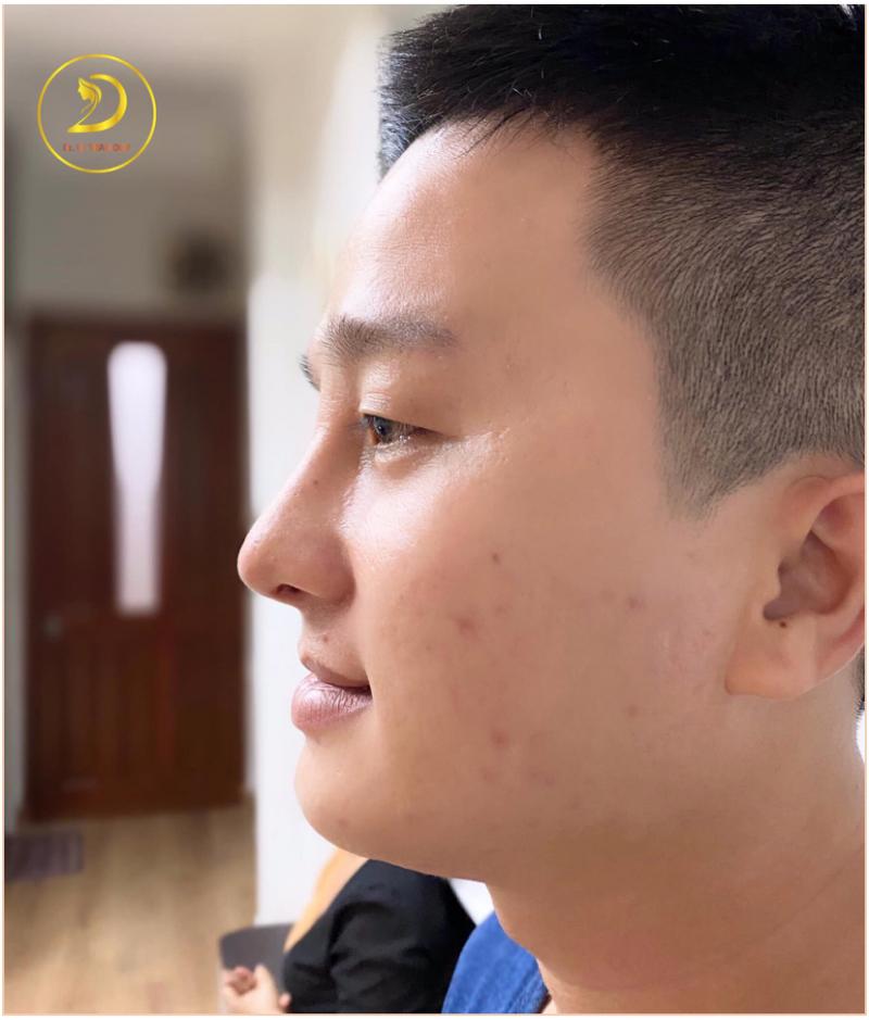 Nâng Mũi Nam Cực Đẹp - Bác sĩ nâng mũi Lê Trần Duy