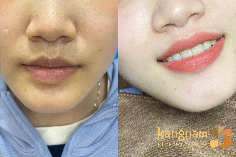 Viện Thẩm mỹ Kangnam Bắc Ninh