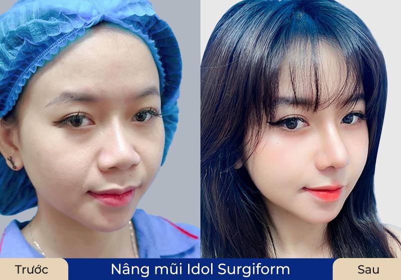 L.T.T sở hữu dáng mũi cao tự nhiên sau khi nâng mũi Idol tại Kangnam Đà Nẵng