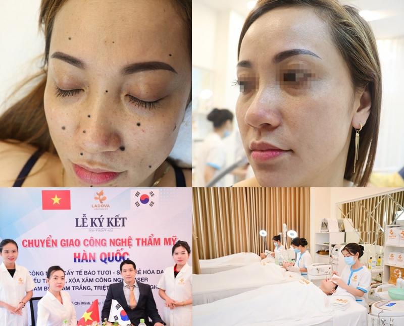 Kết quả tẩy xóa nốt ruồi tại Ladova